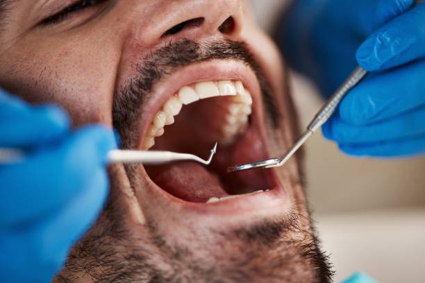 Best Emergency Dentist for Knocked-Out Tooth in Childersburg, AL